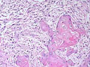 Гистологические виды рака молочной железы 42