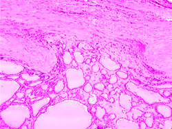 Рак щитовидной железы - гистологические формы