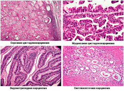 Рак яичников - гистологические формы