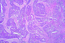 Рак эндометрия - гистологические формы