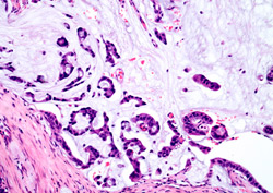 Рак желудка - гистологические формы