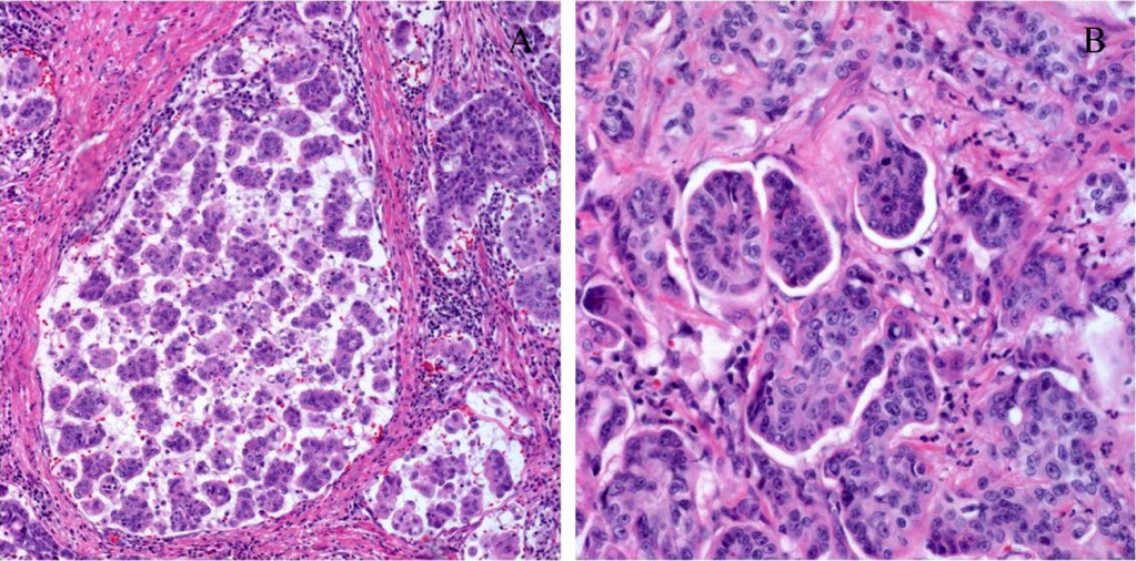 Гистологическая картина рака желудка thumbnail