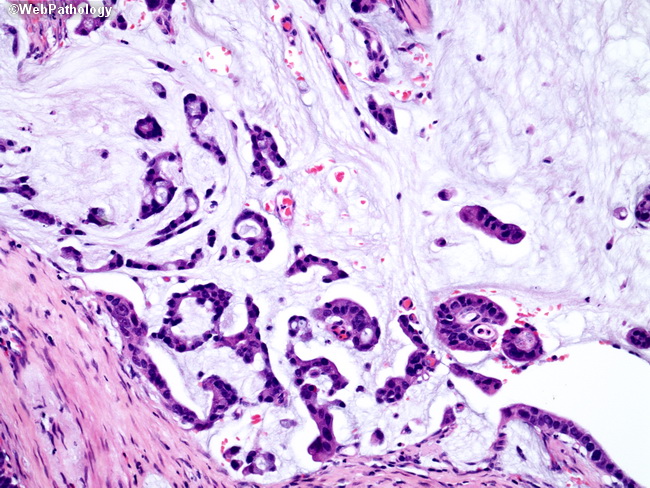 Желудок рак формы микроскопически thumbnail