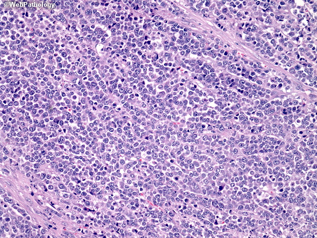 Гистологическое строение рака желудка thumbnail